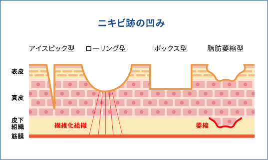 ニキビ跡の凹み